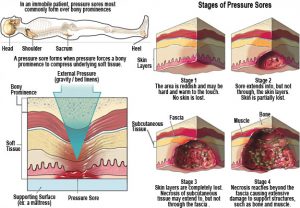 Pressure Sores Ulcers Treatments - CABOT Skin Care - P.O.L. CREAM